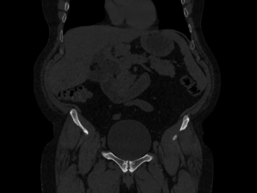 Ankylosing spondylitis (Radiopaedia 44609-48357 Coronal bone window 5).jpg