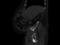 Ankylosing spondylitis (Radiopaedia 44609-48357 Sagittal bone window 15).jpg