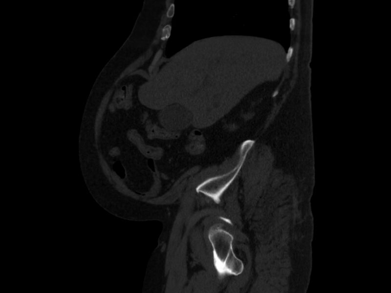 File:Ankylosing spondylitis (Radiopaedia 44609-48357 Sagittal bone window 15).jpg