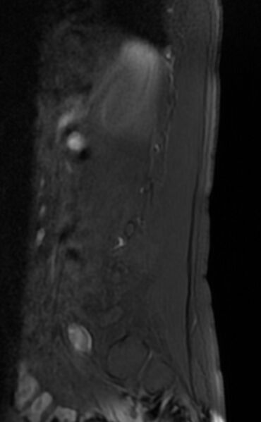 File:Ankylosing spondylitis - Andersson lesion (Radiopaedia 81878-95838 Sagittal T1 fat sat 11).jpg