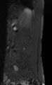 Ankylosing spondylitis - Andersson lesion (Radiopaedia 81878-95838 Sagittal T1 fat sat 11).jpg