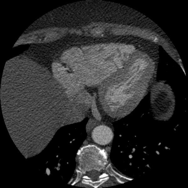 File:Anomalous origin of left circumflex artery from right coronary sinus (Radiopaedia 72563-83117 B 140).jpg