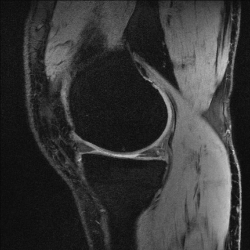 Anterior cruciate ligament mucoid degeneration (Radiopaedia 68400-77933 Sagittal 48).jpg