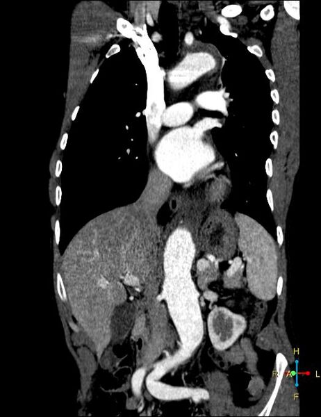 File:Aortic aneurysm and penetrating ulcer (Radiopaedia 23590-23704 B 6).jpg