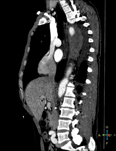 File:Aortic aneurysm and penetrating ulcer (Radiopaedia 23590-23704 C 27).jpg