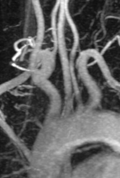 File:Aortic arch origin of left vertebral artery (Radiopaedia 14348-14261 MRA 1).jpg