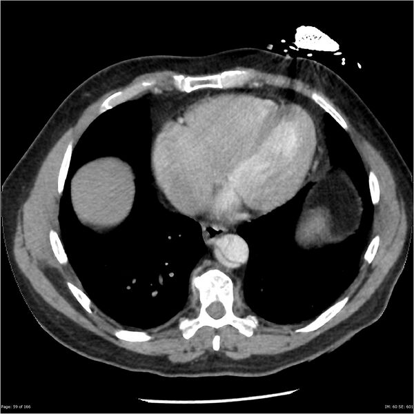 File:Aortic dissection- Stanford A (Radiopaedia 37759-39664 A 50).jpg