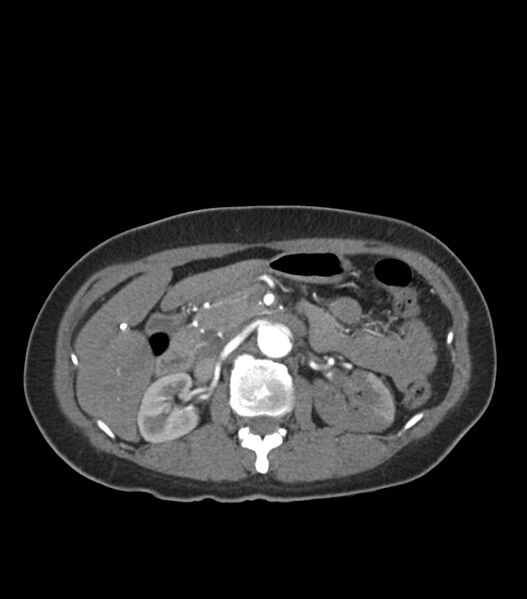 File:Aortic dissection with renal ischemia (Radiopaedia 76573-88338 A 67).jpg