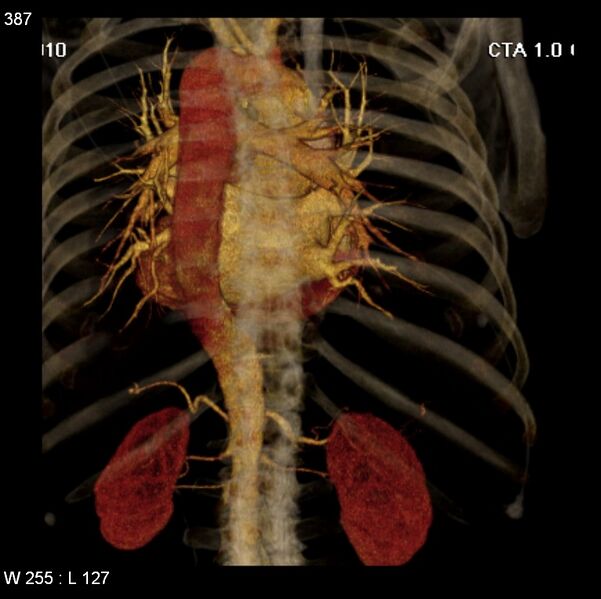 File:Aortic dissection with rupture into pericardium (Radiopaedia 12384-12647 C+ arterial phase 19).jpg