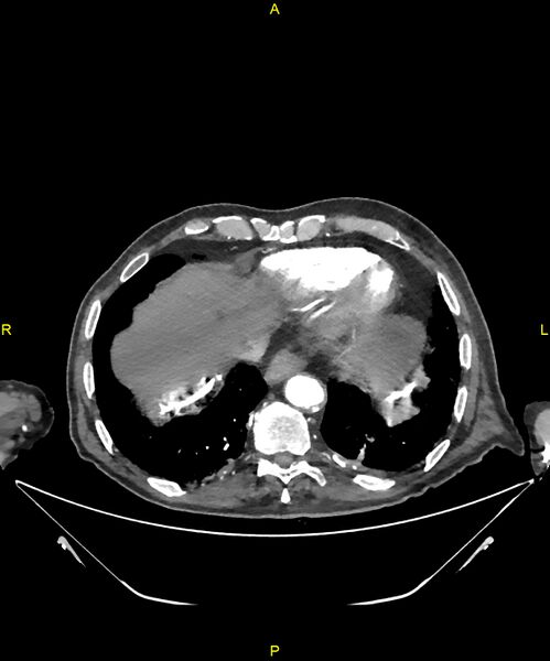 File:Aortoenteric fistula (Radiopaedia 84308-99603 B 16).jpg
