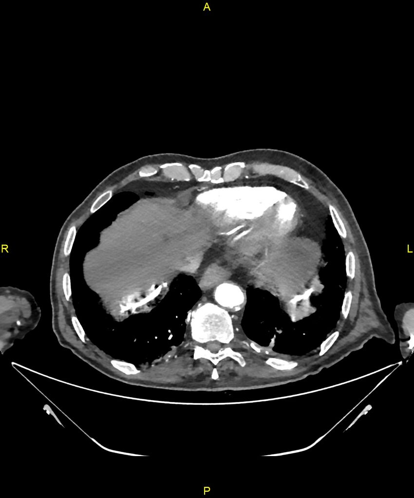 Aortoenteric fistula (Radiopaedia 84308-99603 B 16).jpg