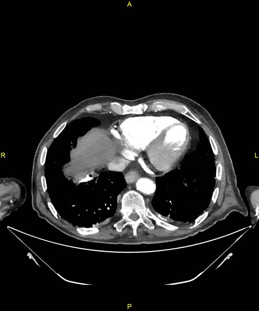 Aortoenteric fistula (Radiopaedia 84308-99603 B 8).jpg