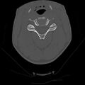 Apical pneumothorax on cervical spine CT (Radiopaedia 45343-49368 Axial bone window 38).jpg