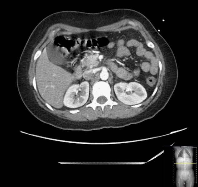 File:Appendicitis (CT angiogram) (Radiopaedia 154713-127660 Axial 133).jpg