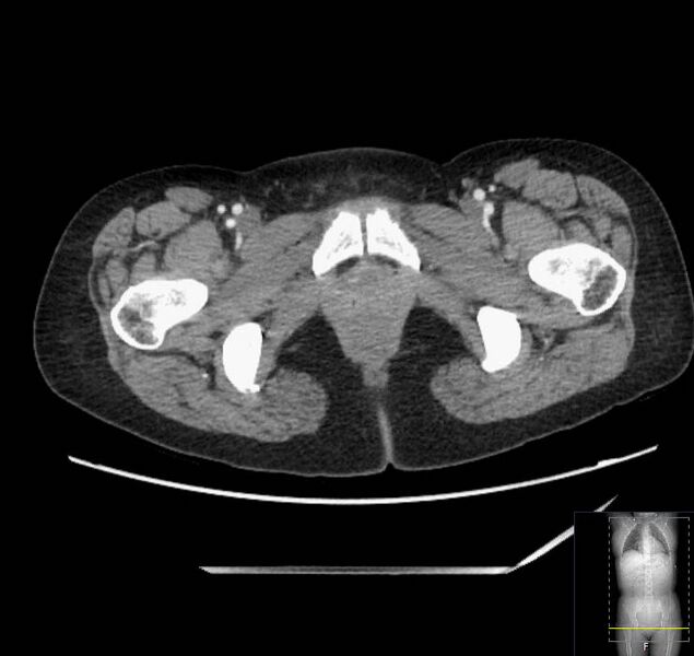 File:Appendicitis (CT angiogram) (Radiopaedia 154713-127660 Axial 92).jpg