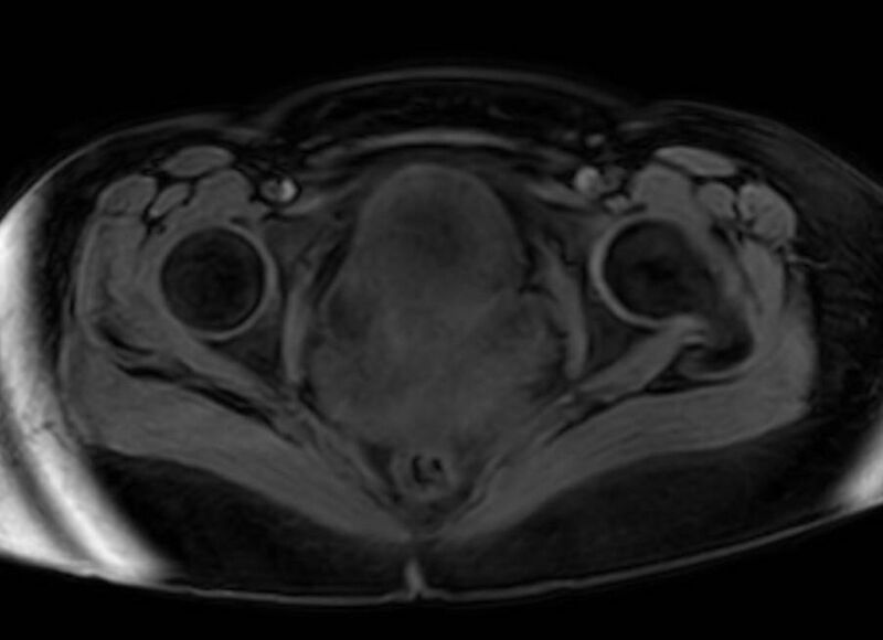 File:Appendicitis in gravida (MRI) (Radiopaedia 89433-106395 Axial DIXON 142).jpg