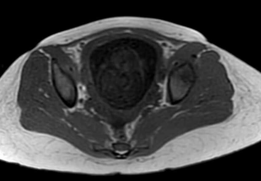 Appendicitis in gravida (MRI) (Radiopaedia 89433-106395 Axial T1 in-phase 60).jpg
