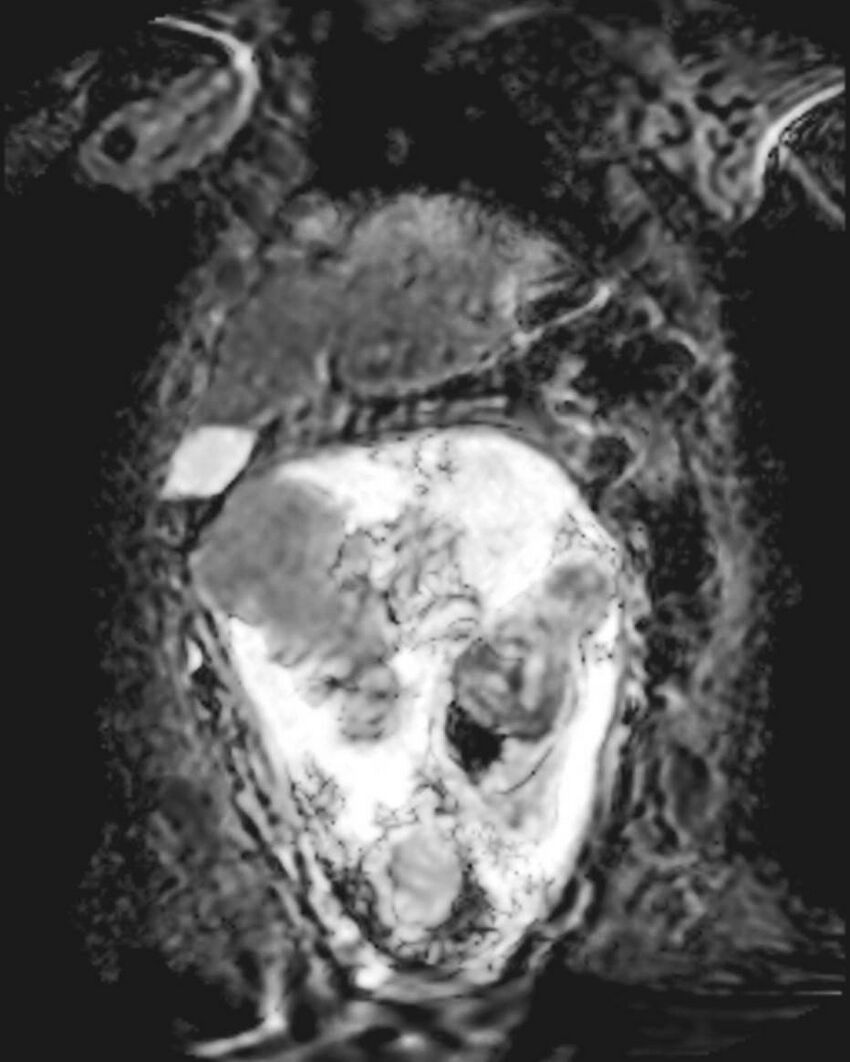 Appendicitis in gravida (MRI) (Radiopaedia 89433-106395 Coronal ADC 18).jpg