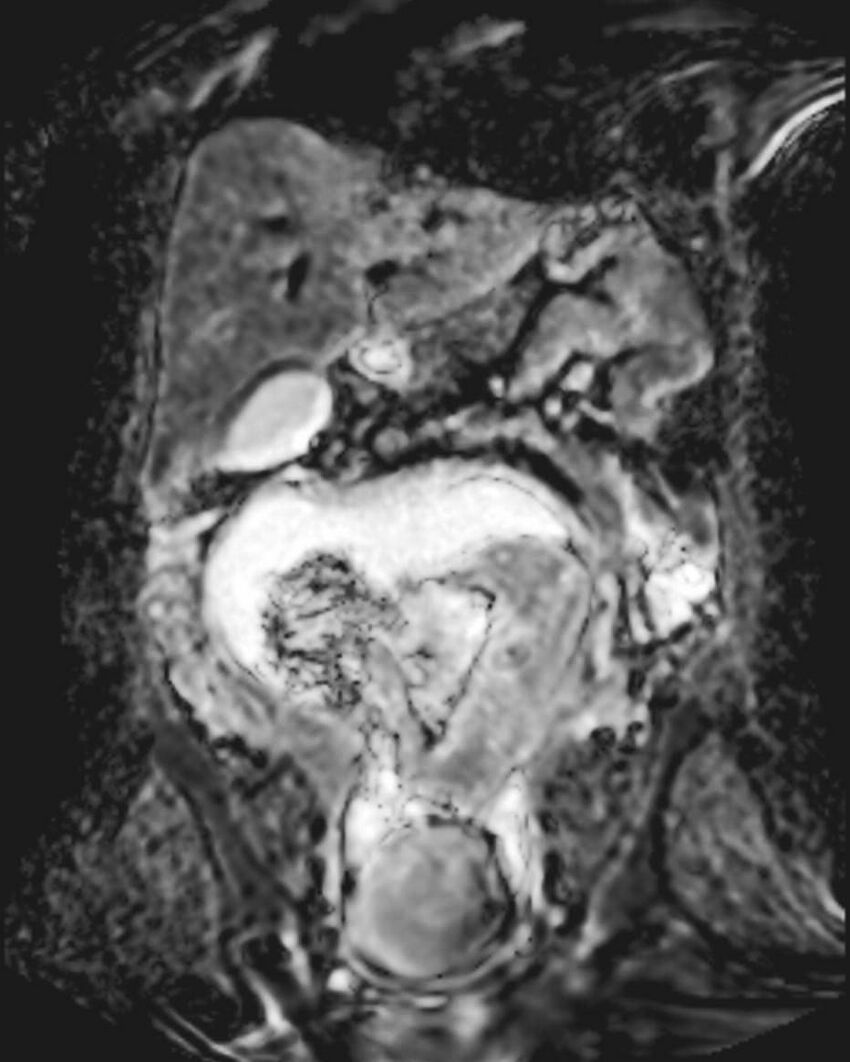 Appendicitis in gravida (MRI) (Radiopaedia 89433-106395 Coronal ADC 26).jpg