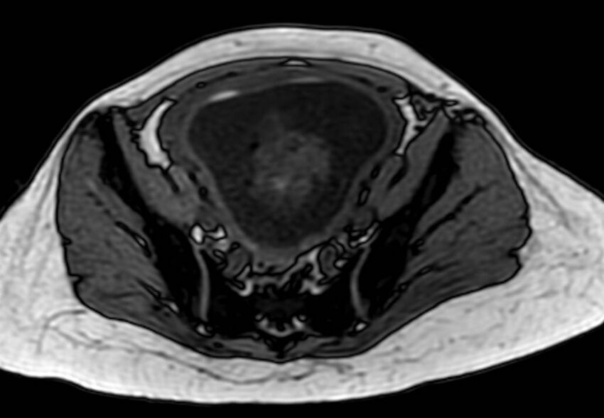 Appendicitis in gravida (MRI) (Radiopaedia 89433-106395 D 55).jpg
