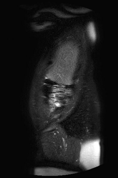 File:Appendicitis in gravida (MRI) (Radiopaedia 89433-106395 Sagittal T2 SPAIR 57).jpg