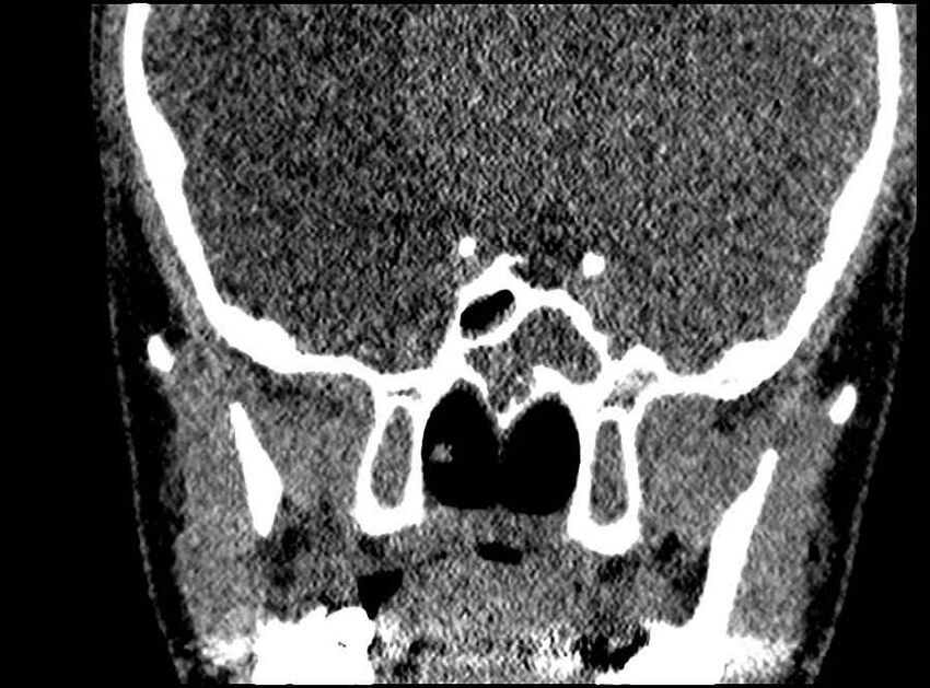 Arachnoid cyst- extremely large (Radiopaedia 68741-78450 Coronal bone window 20).jpg