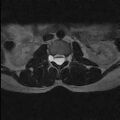Arachnoid cyst - spinal (Radiopaedia 66835-76157 Axial T2 13).jpg