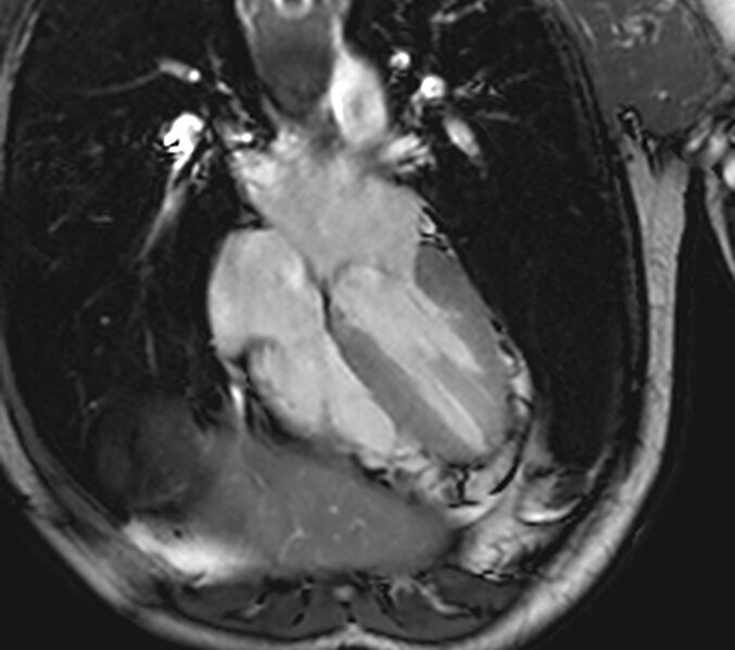 File:Arrhythmogenic right ventricular cardiomyopathy (Radiopaedia 39806-42237 D 81).jpg