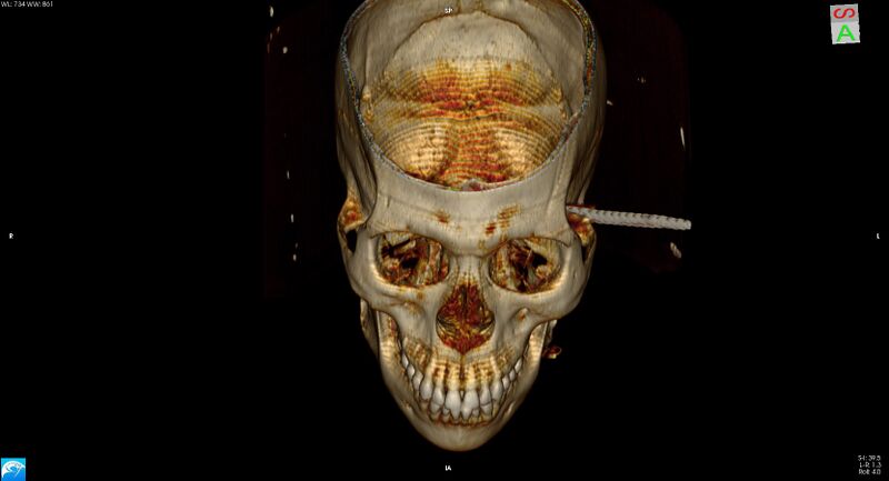 File:Arrow injury to the head (Radiopaedia 75266-86388 3D vertical 10).jpg