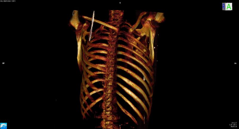 File:Arrow injury to the neck (Radiopaedia 75225-86323 3D bone 39).jpg