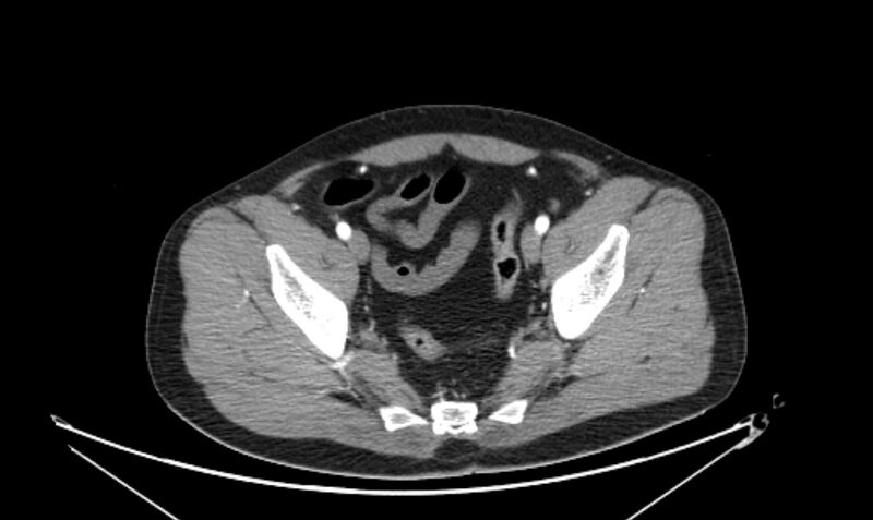 File:Arterial occlusive mesenteric ischemia (Radiopaedia 84641-100060 A 112).jpg