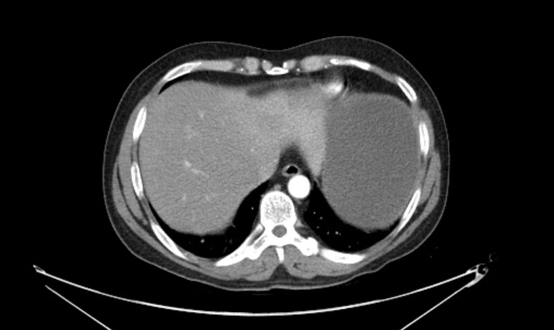 File:Arterial occlusive mesenteric ischemia (Radiopaedia 84641-100060 A 21).jpg