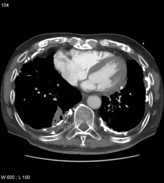 File:Asbestos related lung and pleural disease (Radiopaedia 14377-14301 D 40).jpg