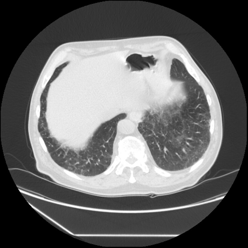 Asbestosis complicated by lung cancer (Radiopaedia 45834-50116 Axial lung window 57).jpg