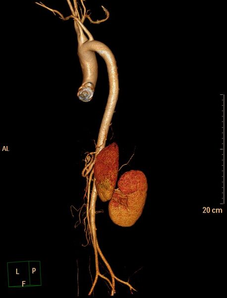 File:Ascending aortic pseudoaneurysm (Radiopaedia 28638-28910 D 23).jpg