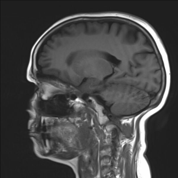 File:Atlanto-occipital assimilation with basilar invagination (Radiopaedia 70122-80157 Sagittal T1 9).jpg