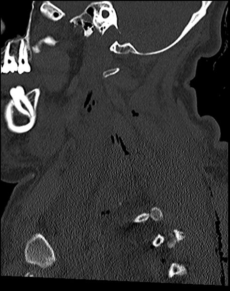 File:Atlanto-occipital dissociation - Traynelis type 1 (Radiopaedia 87570-103948 Sagittal bone window 30).jpg