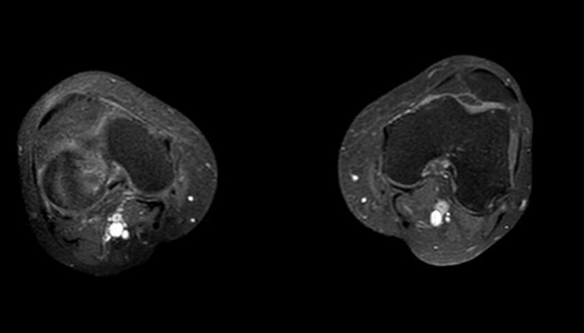 Atypical lipomatous tumor - thigh (Radiopaedia 68975-78734 Axial T1 C+ fat sat 8).jpg