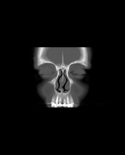 File:Automastoidectomy with labyrinthine fistula (Radiopaedia 84143-99411 Coronal non-contrast 7).jpg
