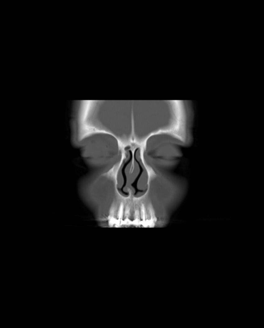 Automastoidectomy with labyrinthine fistula (Radiopaedia 84143-99411 Coronal non-contrast 7).jpg