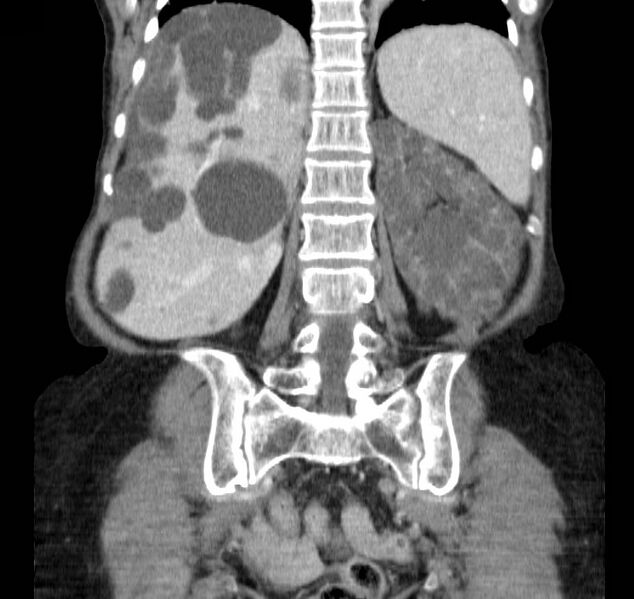 File:Autosomal dominant polycystic kidney disease (Radiopaedia 16777-16490 B 34).jpg