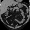 Autosomal dominant polycystic kidney disease (Radiopaedia 36539-38101 Coronal non-contrast 3).jpg
