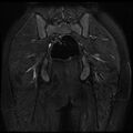 Avascular necrosis of the hip (Radiopaedia 29563-30067 Coronal T2 fat sat 15).jpg