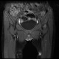 Avascular necrosis of the hip (Radiopaedia 29563-30067 I 2).jpg