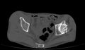Avascular necrosis of the left hip (Radiopaedia 75068-86125 Axial bone window 19).jpg