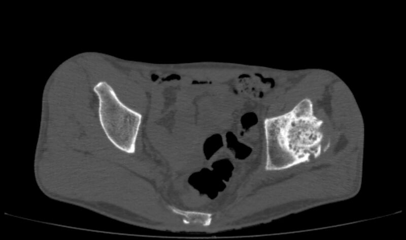 File:Avascular necrosis of the left hip (Radiopaedia 75068-86125 Axial bone window 19).jpg