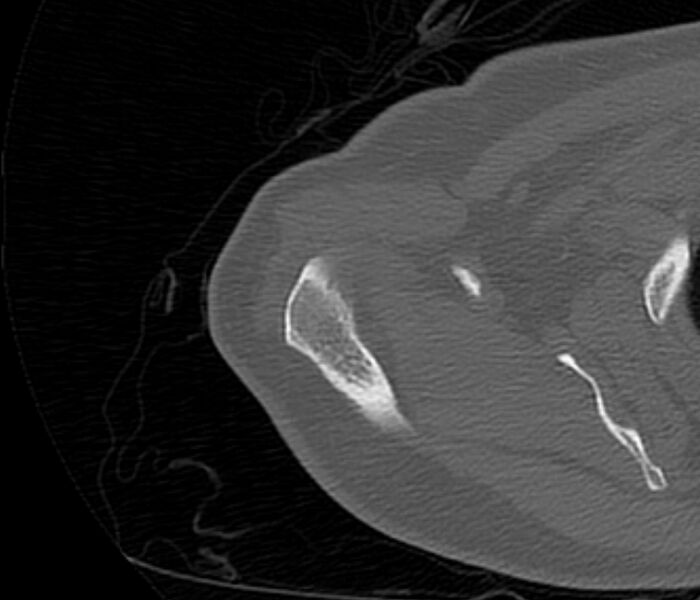 File:Avulsion fracture - greater tuberosity of humerus (Radiopaedia 71216-81514 Axial bone window 16).jpg