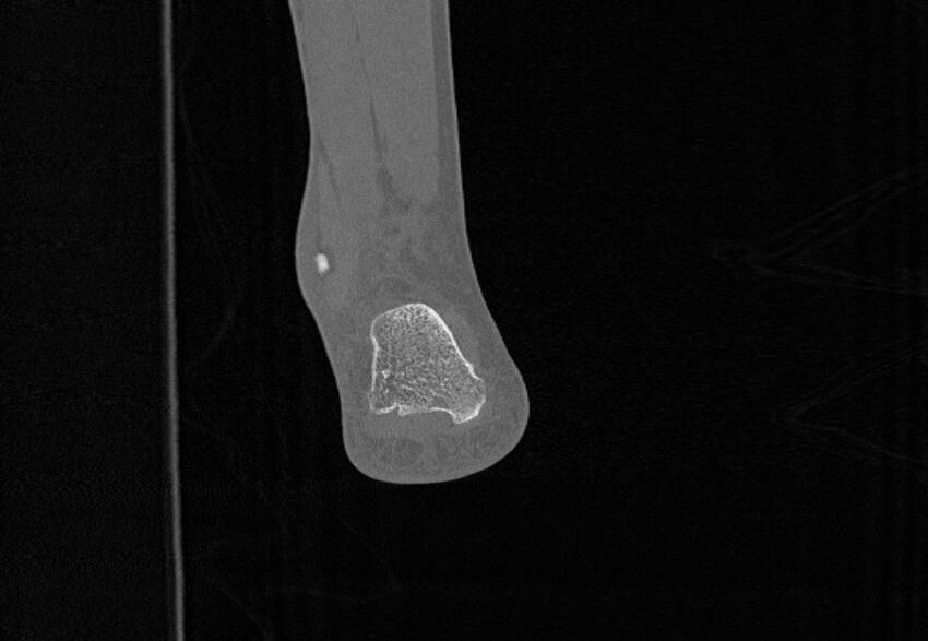 Avulsion fractures of talus and calcaneus (Radiopaedia 48277-53155 Coronal bone window 93).jpg