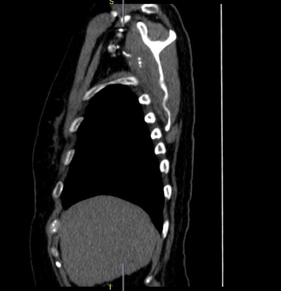 File:Azygos vein aneurysm (Radiopaedia 77824-90130 D 31).JPG