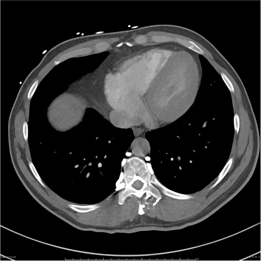 Azygos venous system anatomy (CT pulmonary angiography) (Radiopaedia 25928-26077 Axial C+ CTPA 67).jpg